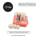 Implant with Bridges Model – Ideal for Education & Training - Denmax Dental